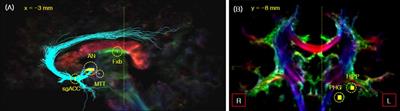 Papez Circuit Observed by in vivo Human Brain With 7.0T MRI Super-Resolution Track Density Imaging and Track Tracing